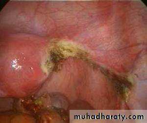 Treatment of Ectopic pregnancy