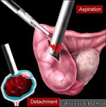 Treatment of Ectopic pregnancy