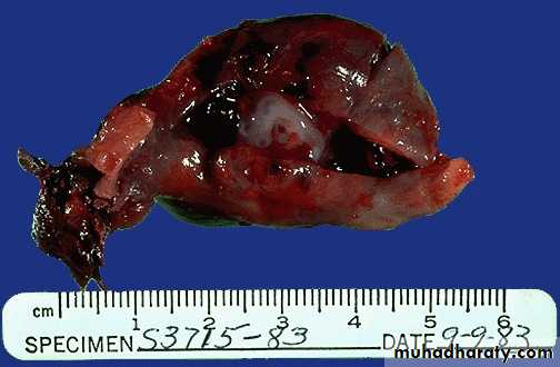 Treatment of Ectopic pregnancy