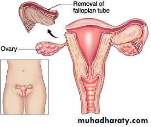 Treatment of Ectopic pregnancy