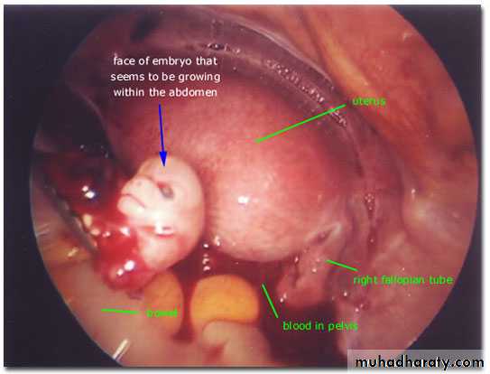 Treatment of Ectopic pregnancy