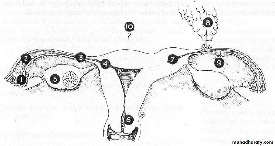 Treatment of Ectopic pregnancy