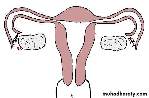 Treatment of Ectopic pregnancy