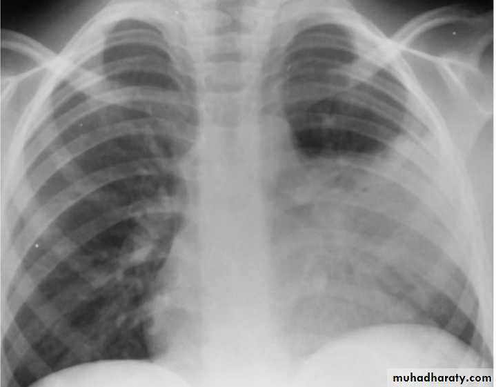 Pneumonia