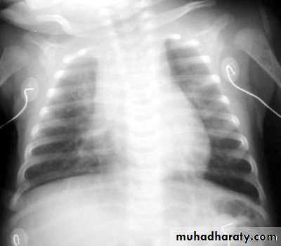Pneumonia
