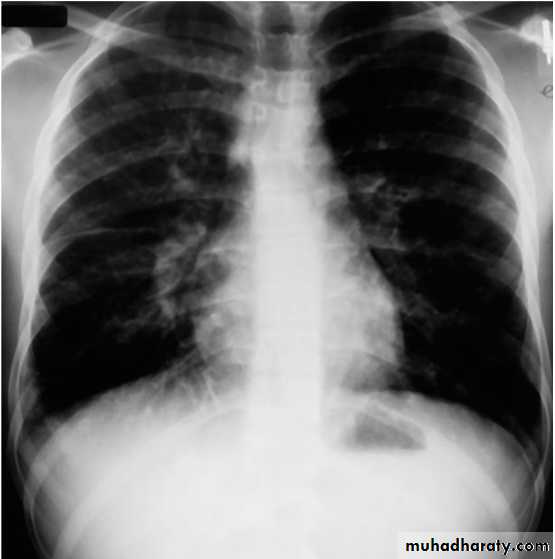 Pneumonia