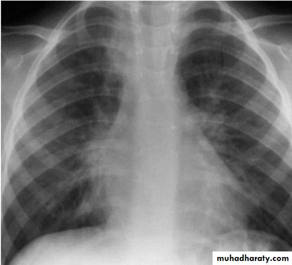 Pneumonia