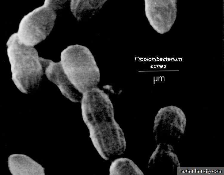 Acne Vulgaris