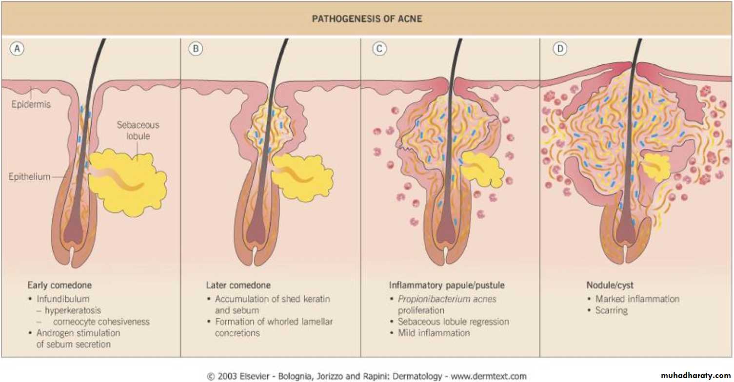 Acne Vulgaris