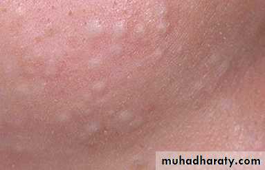 Acne Vulgaris