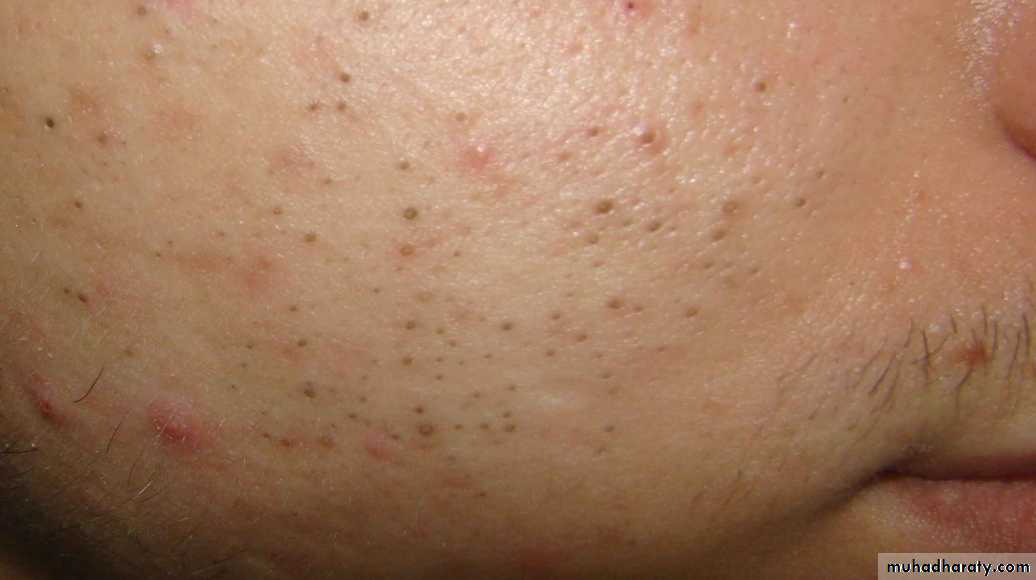 Acne Vulgaris