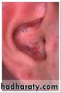 Acne Vulgaris