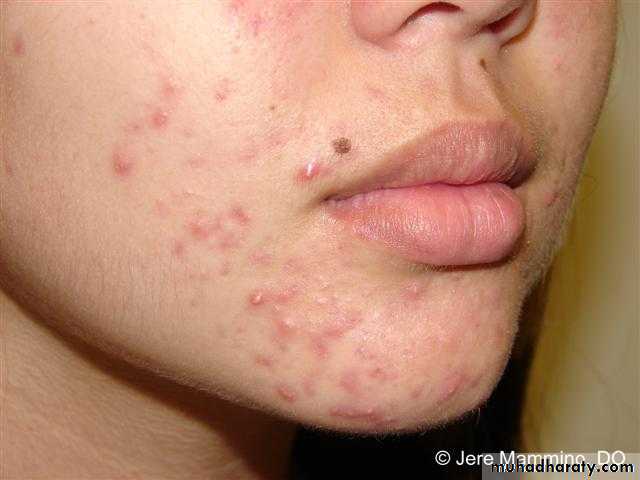 Acne Vulgaris