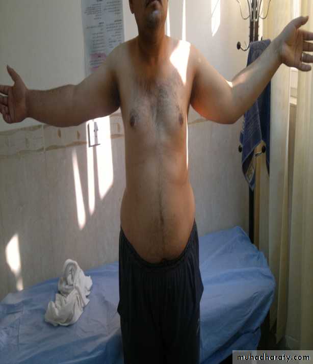 The Elbow