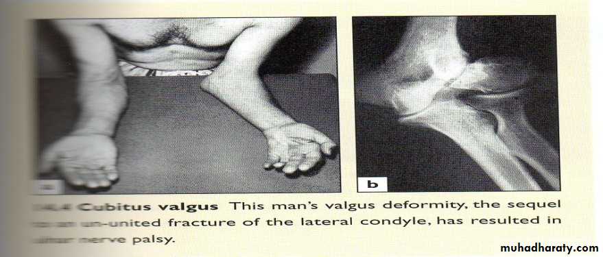 The Elbow