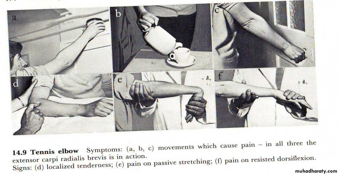 The Elbow