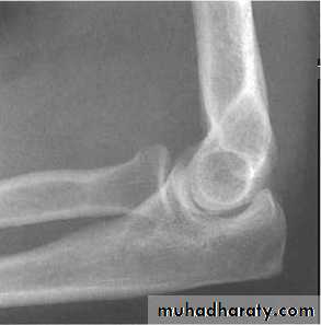 The Elbow