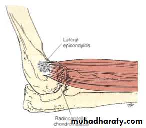 The Elbow