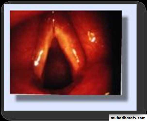 The larynx