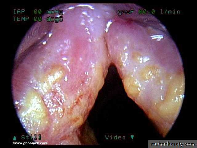 The larynx