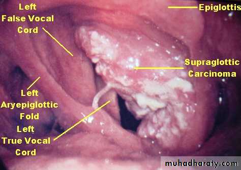 The larynx