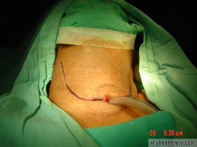 The larynx