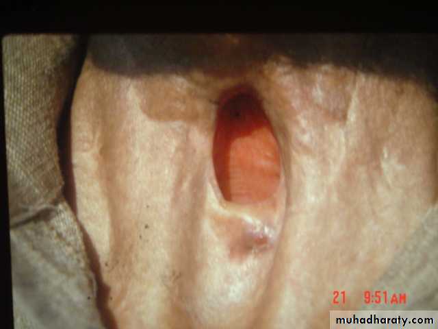 The larynx