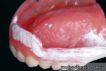 Complete denture