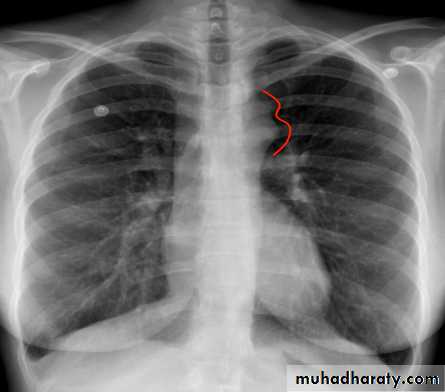 Acyanotic-Congenital-Heart-Disease