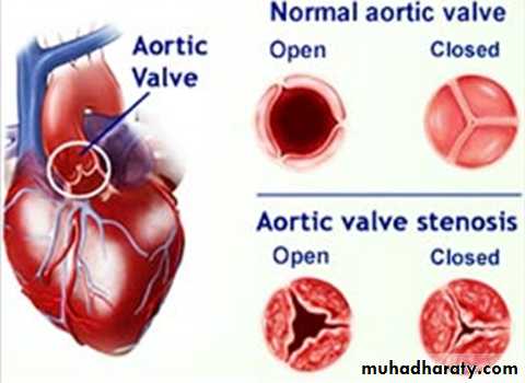 Acyanotic-Congenital-Heart-Disease