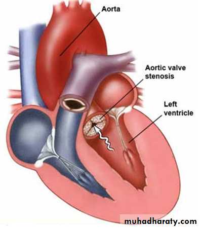 Acyanotic-Congenital-Heart-Disease