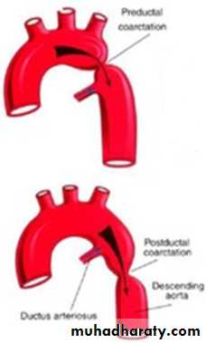 Acyanotic-Congenital-Heart-Disease