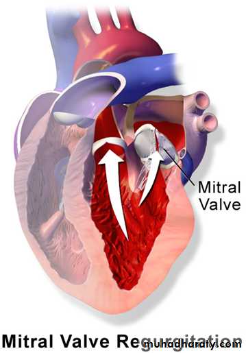 Acyanotic-Congenital-Heart-Disease