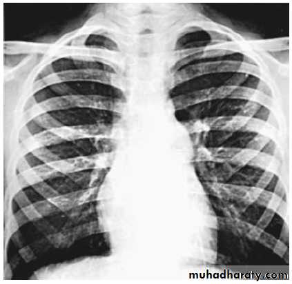Acyanotic-Congenital-Heart-Disease