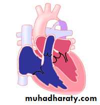 Acyanotic-Congenital-Heart-Disease