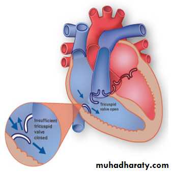 Acyanotic-Congenital-Heart-Disease