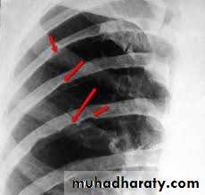 Acyanotic-Congenital-Heart-Disease