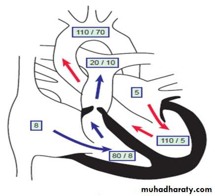 Acyanotic-Congenital-Heart-Disease