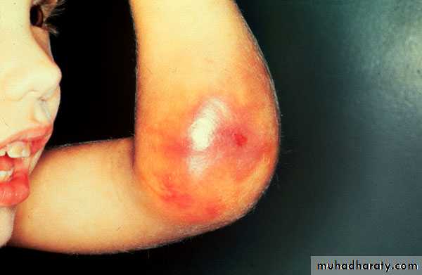 Coagulation disorders