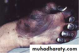 Coagulation disorders