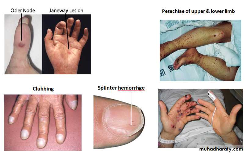 Heart Failure (HF)