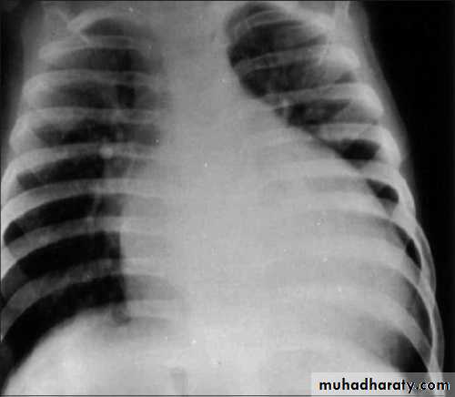 Heart Failure (HF)