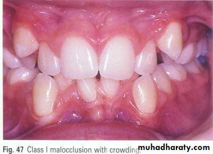 dental crowding and spacing