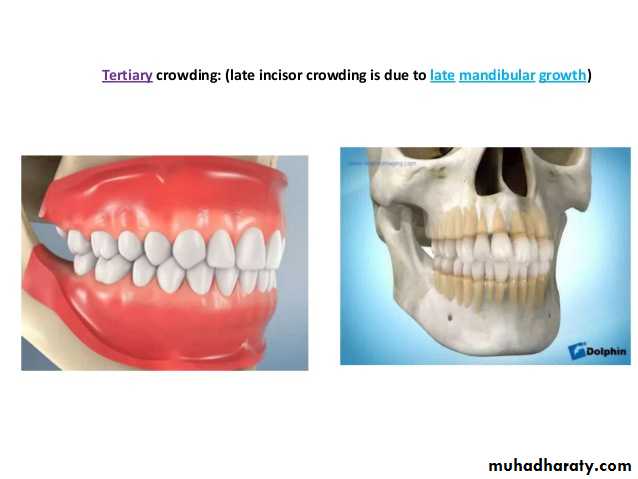 dental crowding and spacing