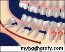 dental crowding and spacing