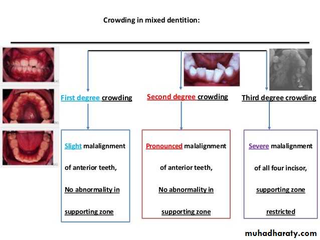 dental crowding and spacing