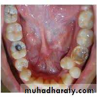 dental crowding and spacing