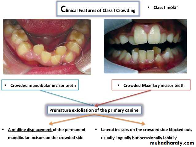 dental crowding and spacing