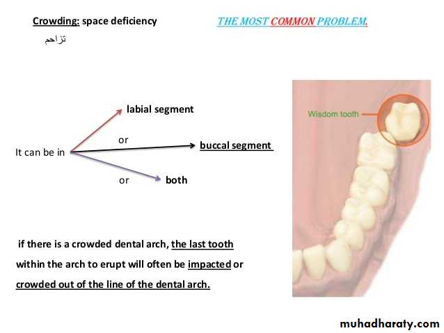 dental crowding and spacing