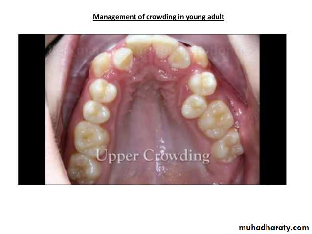 dental crowding and spacing